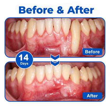 🇬🇧🏅🦷🛡️InnoMedix® GumRevive Periodontal Repair Gel💎💎